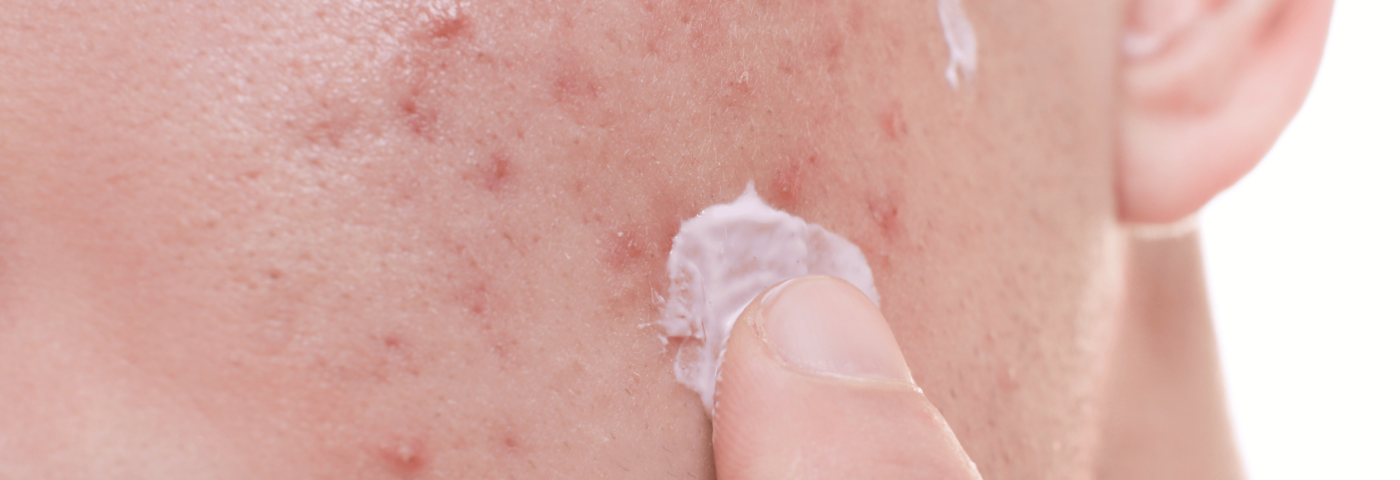 The phage story: the natural solution for blemish-prone skin